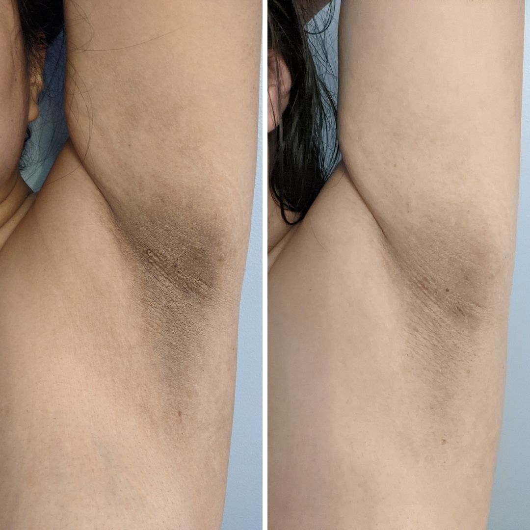 Dark spot oil underarm darkening