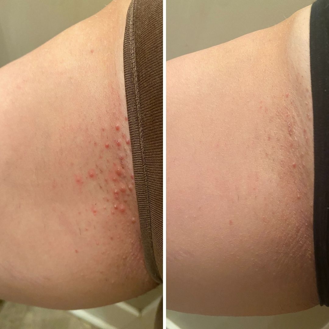 Razor burn on thighs before and after
