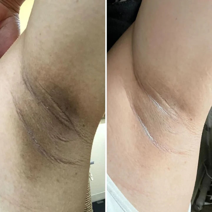 Underarm before and after